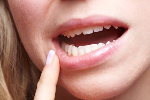 How to prevent gingivitis